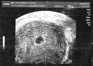 Az első ultrahangos fotó - itt nem látták Edwardot az orvosok