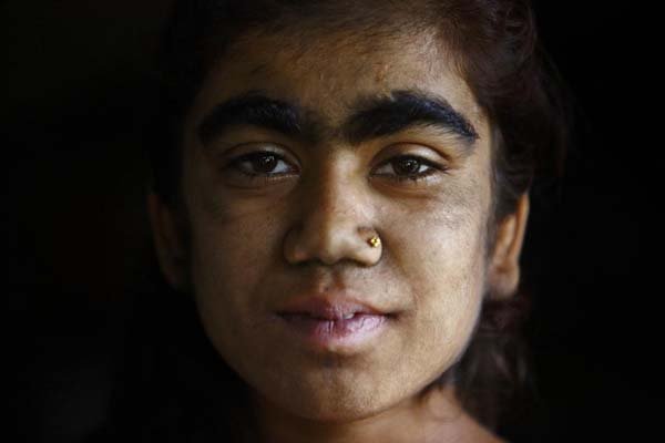 Egy vérfarkas szindrómás család átalakulása 