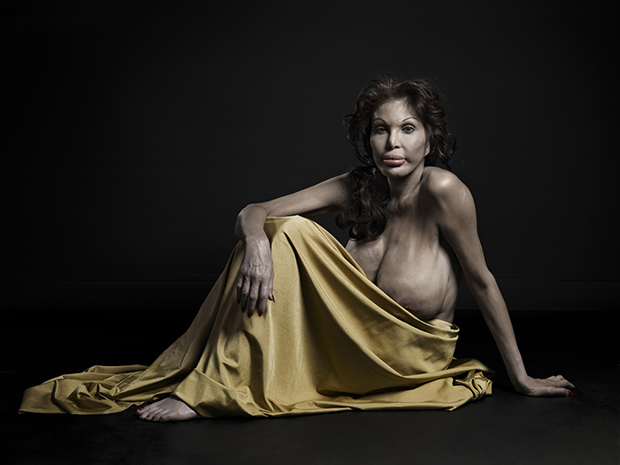 Extrém plasztika: a szépség új formája