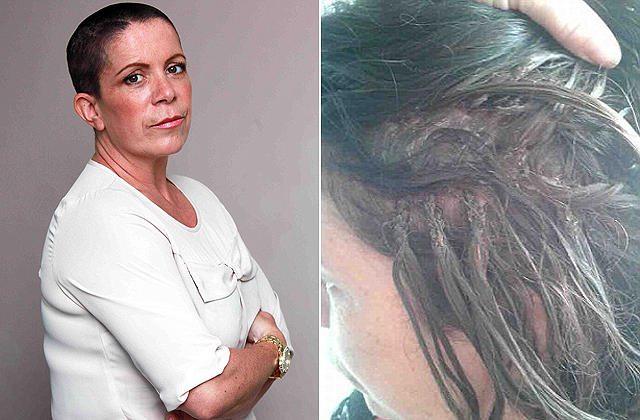 Hajhosszabbítást akart, végül kopaszra kellett borotválni a fejét