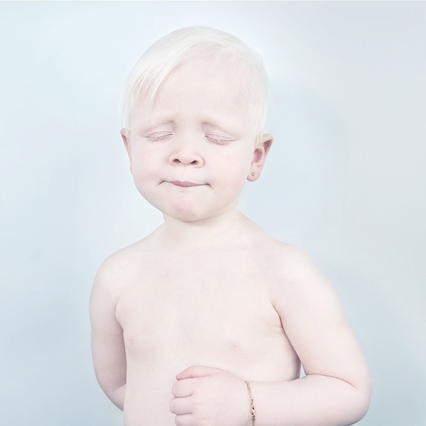 Az albínók is gyönyörűek - galéria