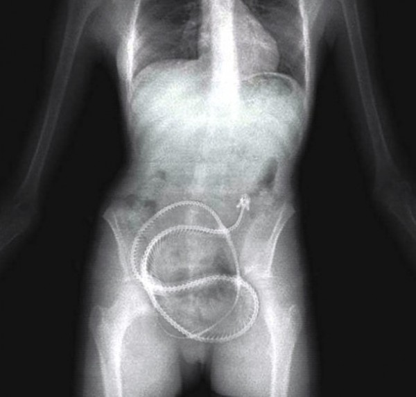 Félelmetes tárgyak a gyomorban. Mi mindent találhattak?