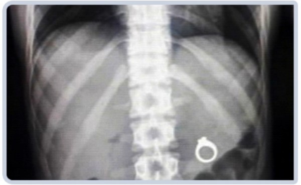 Félelmetes tárgyak a gyomorban. Mi mindent találhattak?