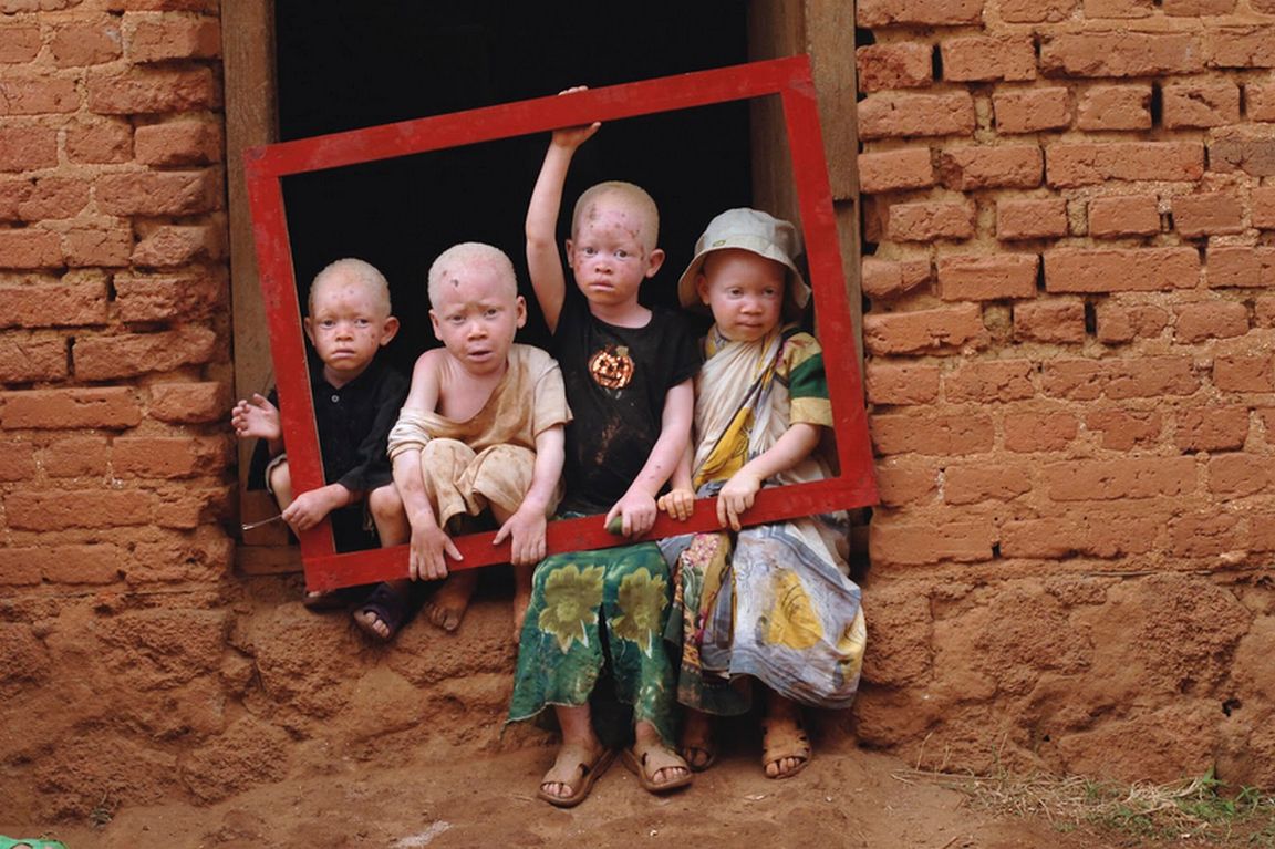 Egy veszélyeztetett faj – Albínók Afrikában