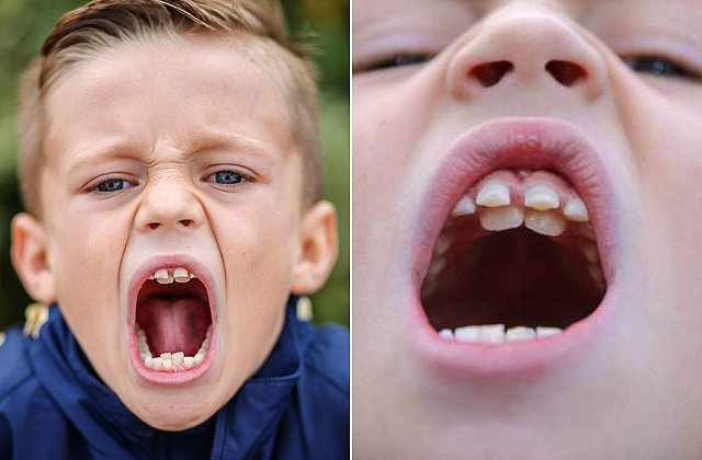Dupla fogsora van egy kisfiúnak