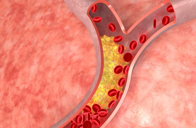 Tegyük tisztába a koleszterint!