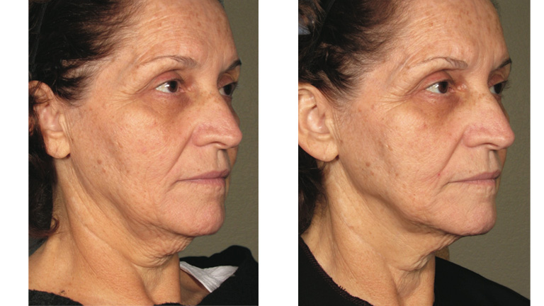 Gallusz Nikolett és Meryl Streep is a természetes, műtét nélküli szépülésben hisz