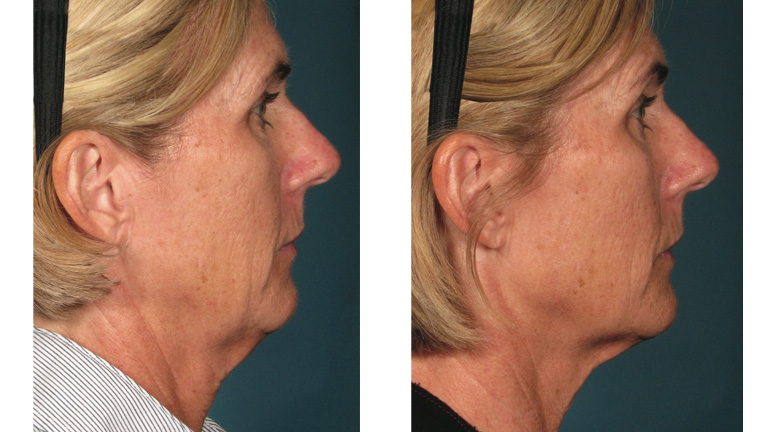 Gallusz Nikolett és Meryl Streep is a természetes, műtét nélküli szépülésben hisz