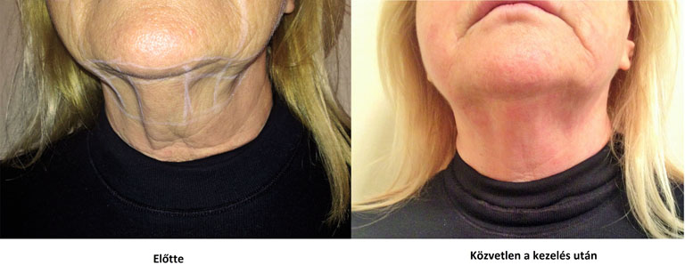 Valóban létezik műtét nélkül arcfiatalítás és ránctalanítás? Utánajártam…