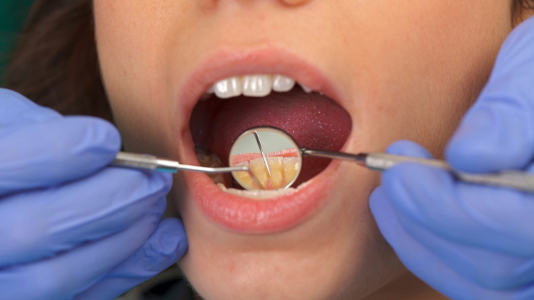 Hihetetlen, de igaz: nem mosnak fogat!