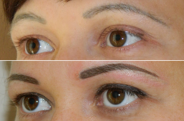 Elrontott szemöldök javítása