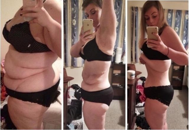 55 kilót fogyott és megszabadulna csúnyán megnyúlt bőrétől is - fotók