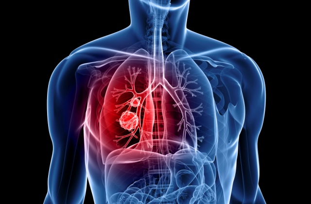 Magyar nők vezetik a tüdőrák világranglistáját – ismerd fel időben a betegséget