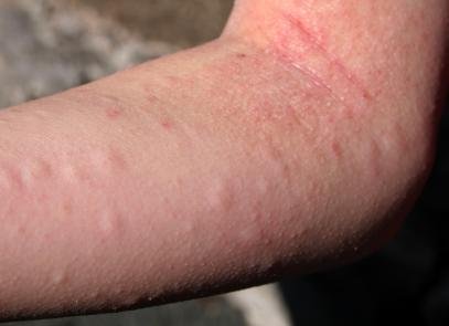 Sokkoló tények az anafilaxiáról