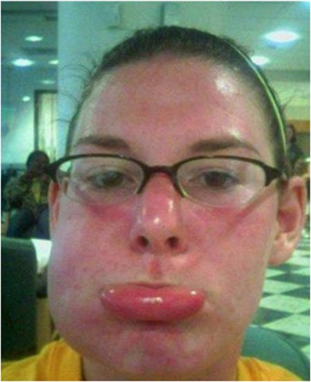 Bedagadt fejek: allergiás szelfik - ez az új őrület Bedagadt fejek: allergiás szelfik - ez az új őrület