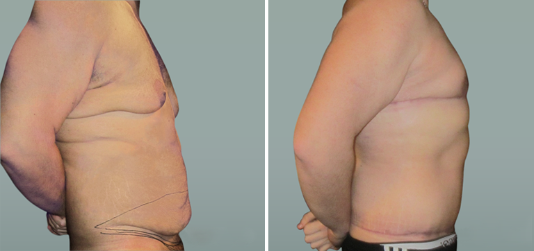 Gábor a beavatkozás előtt és után