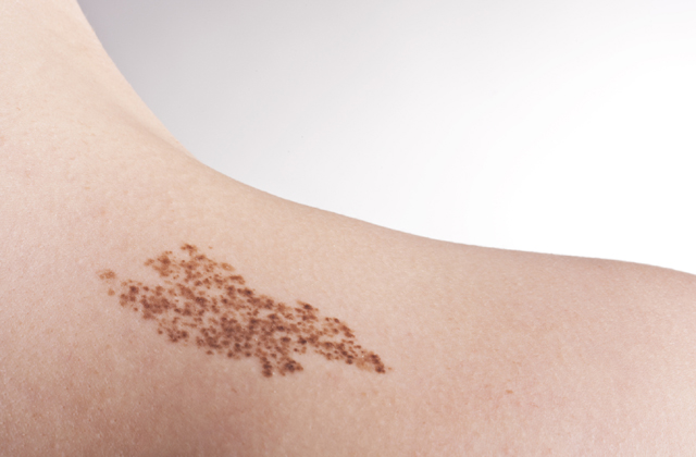 15 bizonyíték arra, hpogy az anyajegyek igenis szépek