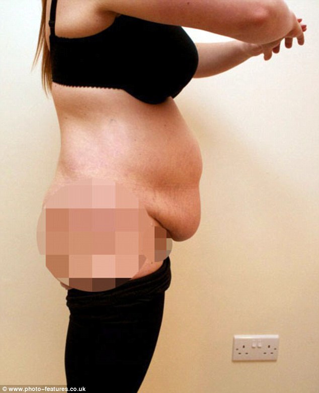 Negyven kilót ledobott, mert elege lett a hasából - fotók