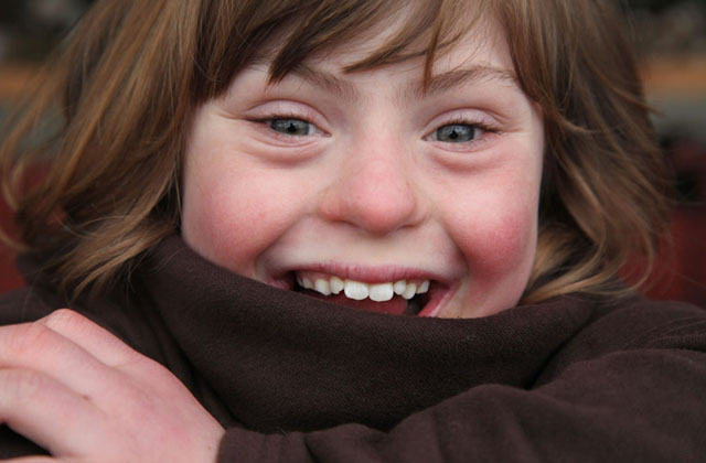 A genetikai rendellenességekkel élők szépségét mutatja meg a fotós - galéria A genetikai rendellenességekkel élők szépségét mutatja meg a fotós - galéria