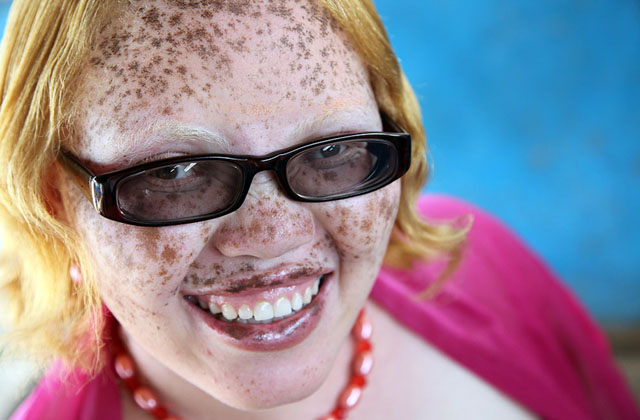 A genetikai rendellenességekkel élők szépségét mutatja meg a fotós - galéria