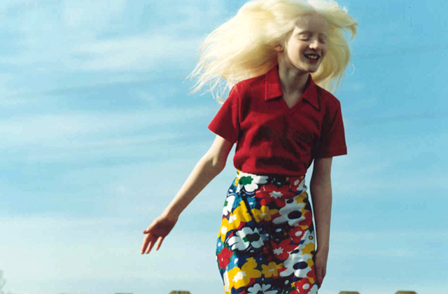 A genetikai rendellenességekkel élők szépségét mutatja meg a fotós - galéria A genetikai rendellenességekkel élők szépségét mutatja meg a fotós - galéria