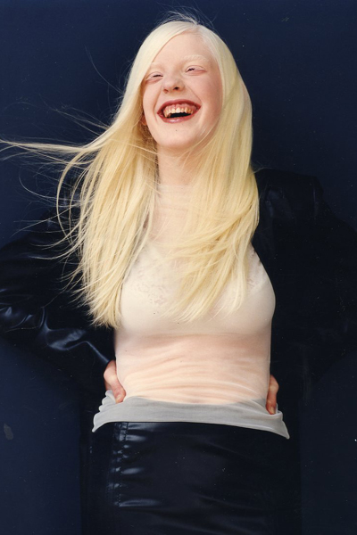 A genetikai rendellenességekkel élők szépségét mutatja meg a fotós - galéria