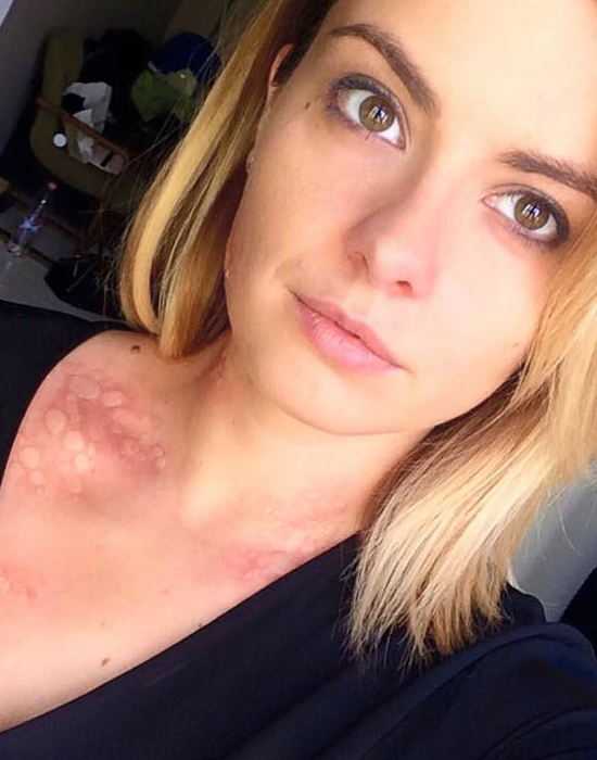 Lola csúnya kiütései Fotó: Lola/Facebook.com
