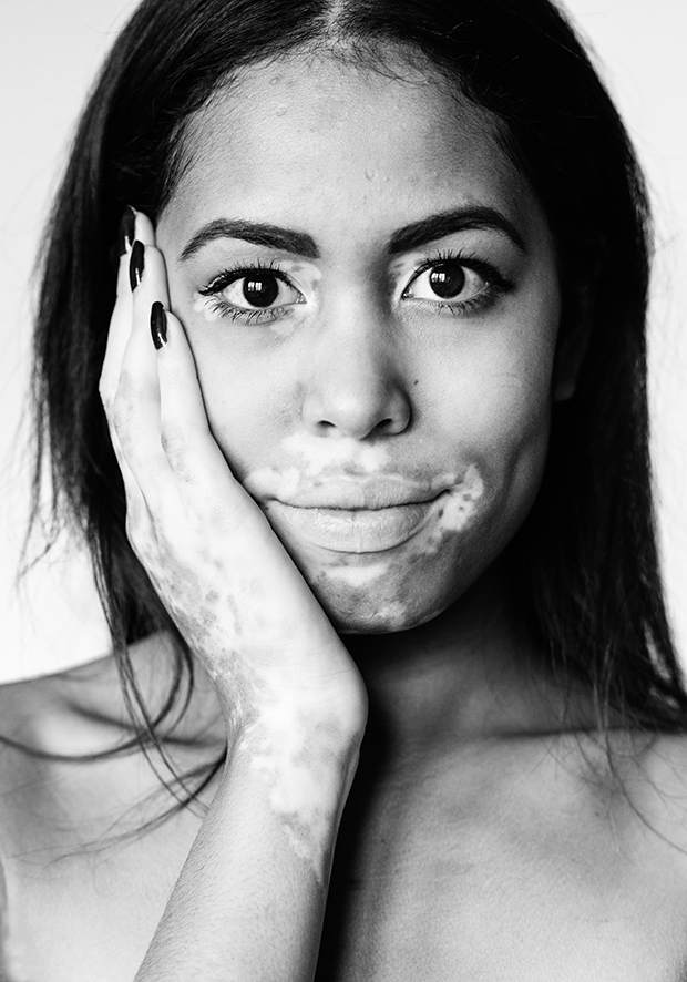 Lásd meg te is a vitiligo szépségét!