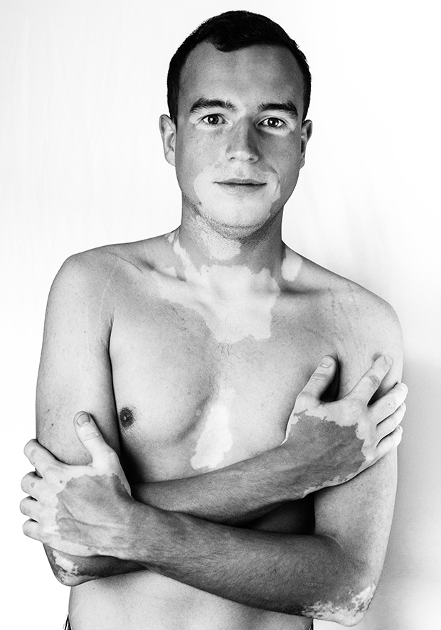 Lásd meg te is a vitiligo szépségét!