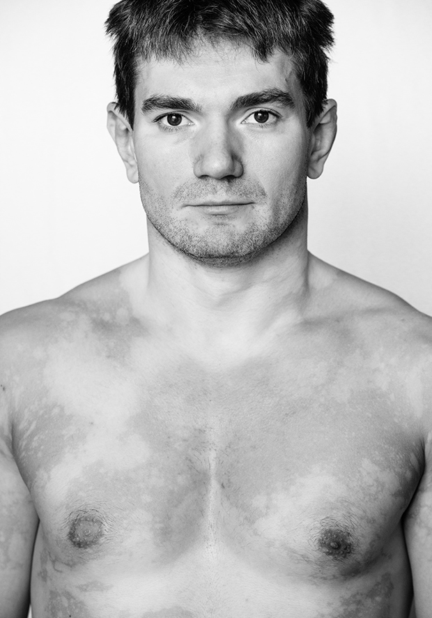 Lásd meg te is a vitiligo szépségét!