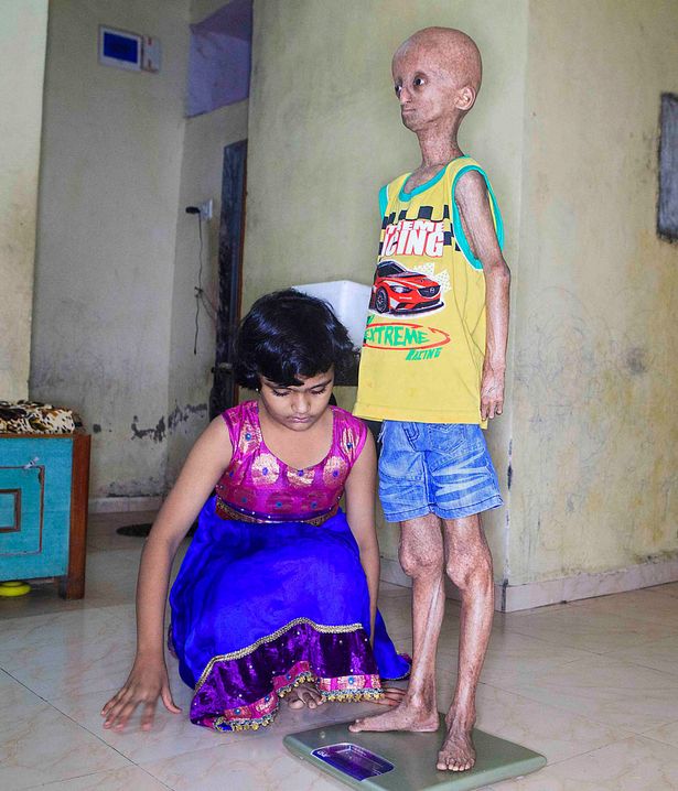 Nyugdíjasnak néz ki a tini, aki nyolcszor gyorsabban öregszik