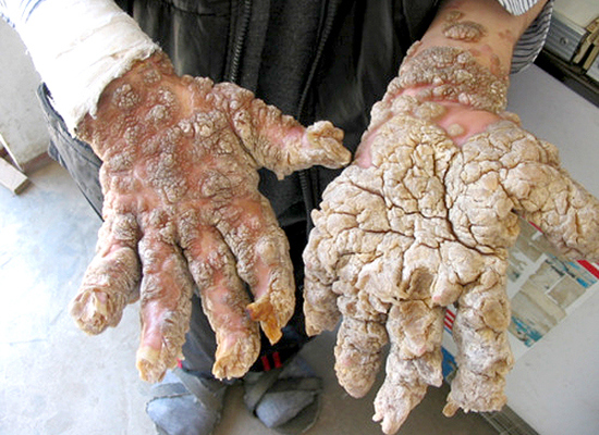 Képeken a világ 10 legdurvább betegsége Képeken a világ 10 legdurvább betegsége