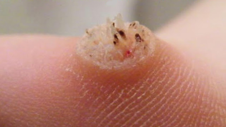 Szemölcsök ellen természetesen!