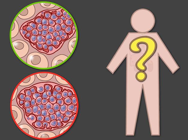 Rákos féreg miatt halt meg egy HIV-fertőzött beteg