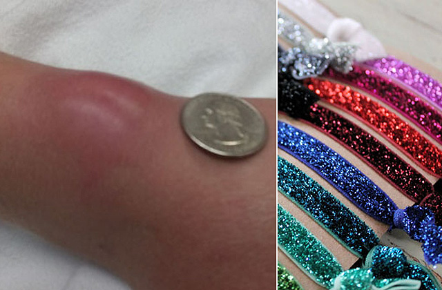 Egy hajgumitól kapott súlyos fertőzést