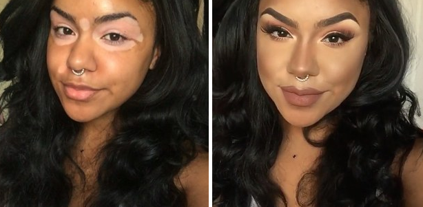 A vitiligo arcai: hihetetlen átváltozás némi smink segítségével