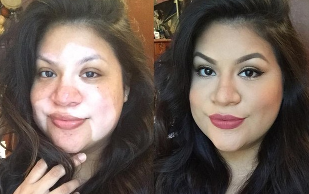 A vitiligo arcai: hihetetlen átváltozás némi smink segítségével