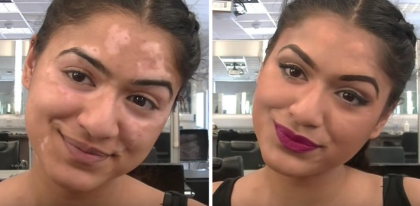 A vitiligo arcai: hihetetlen átváltozás némi smink segítségével
