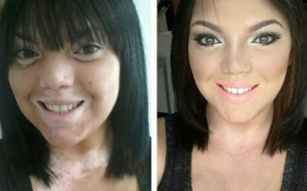 A vitiligo arcai: hihetetlen átváltozás némi smink segítségével