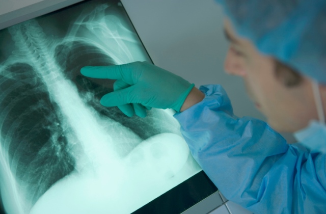 Már elvégezték az első tüdő-transzplantációt Magyarországon