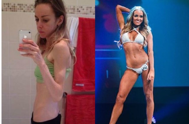 Anorexiásan és a bikini modell versenyen