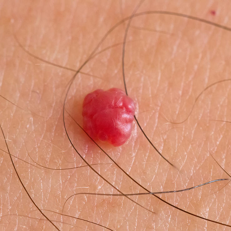 Kinövések a testen - elmondjuk, melyik micsoda