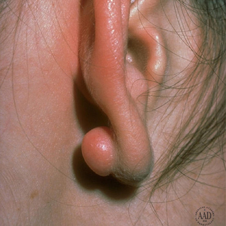 Kinövések a testen - elmondjuk, melyik micsoda