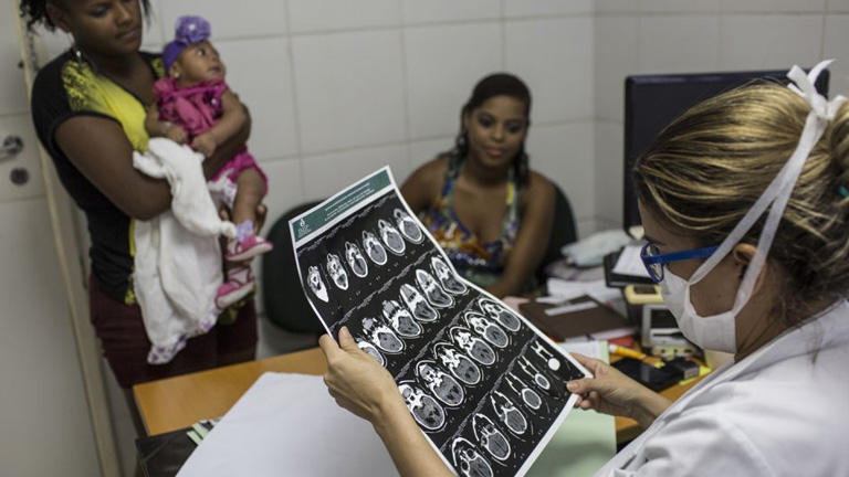 Erős a gyanú, hogy van kapcsolat a zikavírus és a kisfejűség között