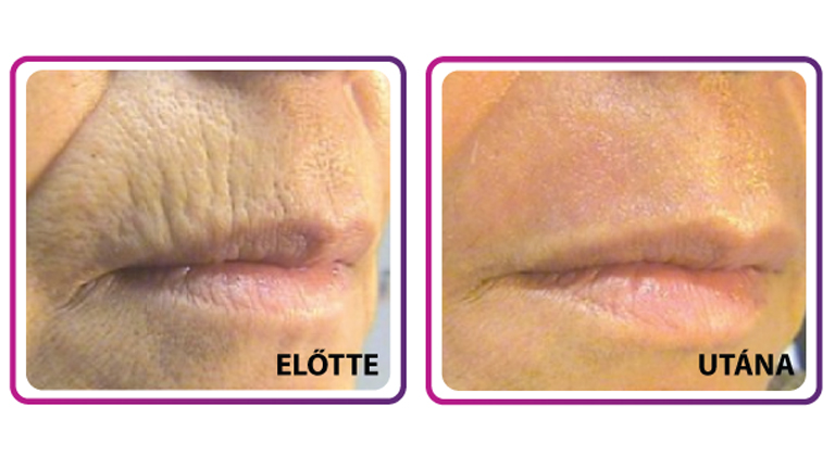 Hazugság a ránctalanító krémekről