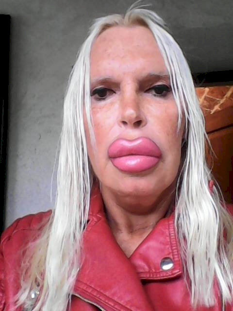 Tízmilliókat költött plasztikára, nagyon csúnya lett - fotók Tízmilliókat költött plasztikára, nagyon csúnya lett - fotók