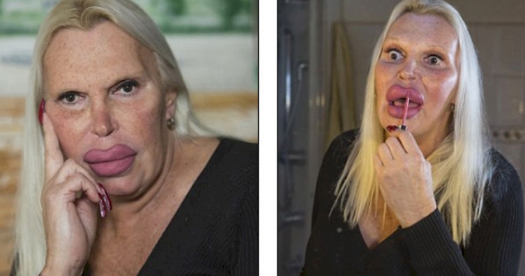 Tízmilliókat költött plasztikára, nagyon csúnya lett - fotók Tízmilliókat költött plasztikára, nagyon csúnya lett - fotók