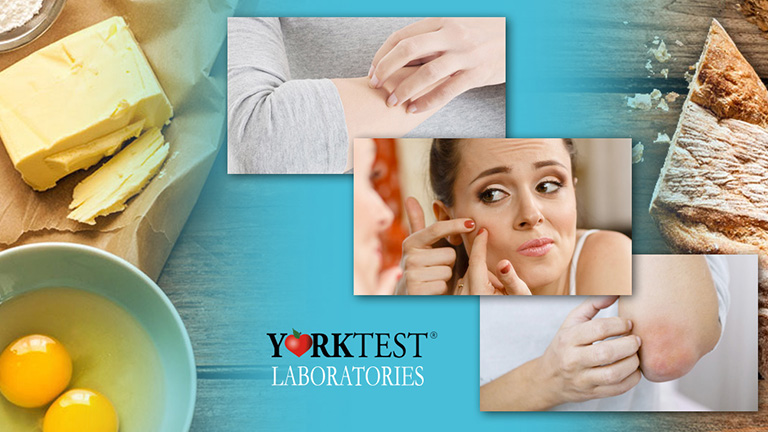 Lehet, hogy bőrproblémáidat ételintolerancia okozza!