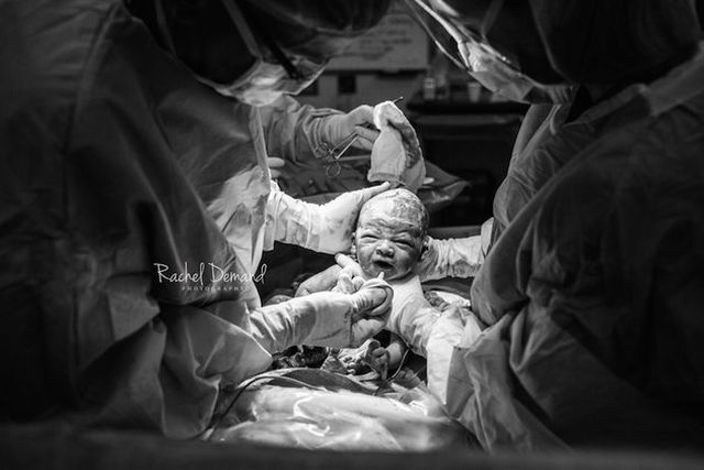 A császármetszés is lehet gyönyörű szülésélmény - megható fotók A császármetszés is lehet gyönyörű szülésélmény - megható fotók