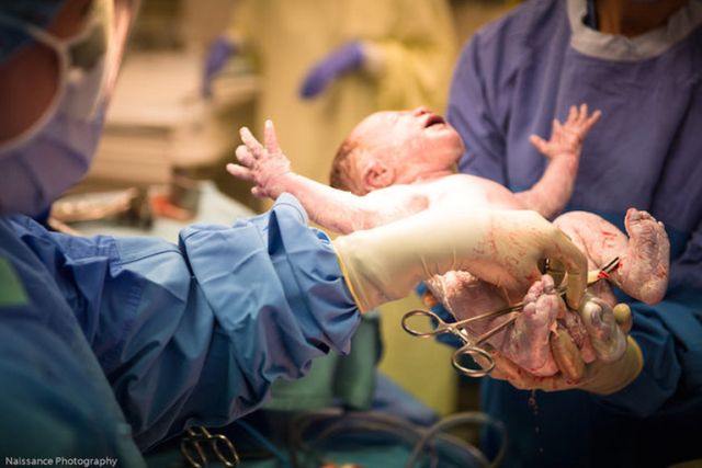 A császármetszés is lehet gyönyörű szülésélmény - megható fotók A császármetszés is lehet gyönyörű szülésélmény - megható fotók